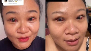 Dokter Ungkap Penyebab Mata Merah Pasca Persalinan: Teknik Mengejan yang Aman untuk Ibu Baru